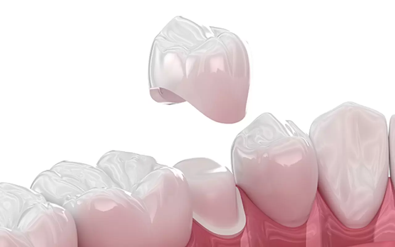 クラウン(被せ物)