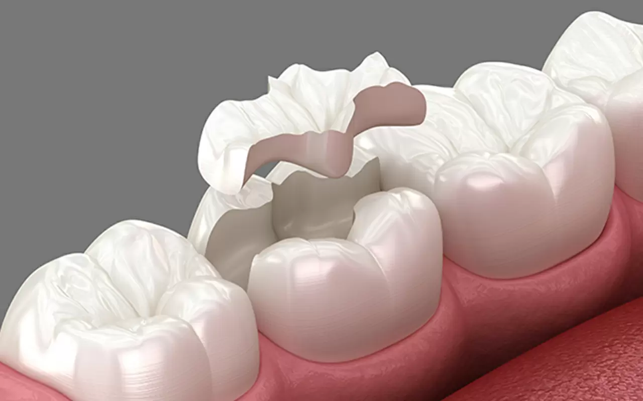 インレー(詰め物)