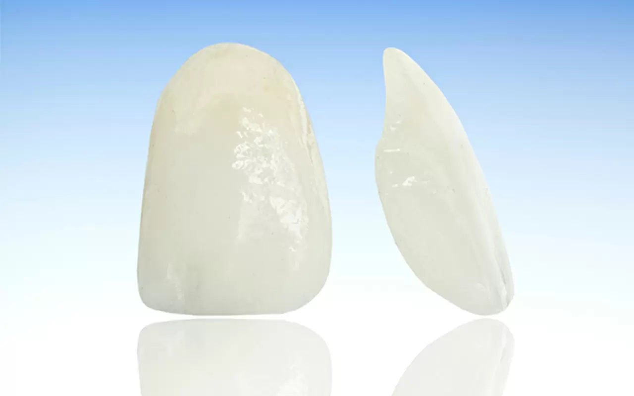 ラミネートベニア