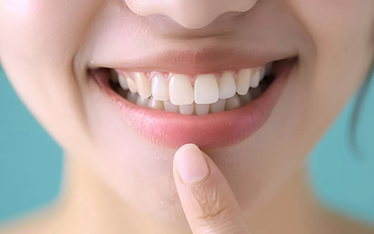 ダイレクトボンディング