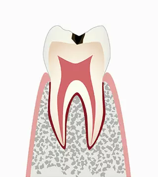 C1（シーワン）:エナメル質の虫歯