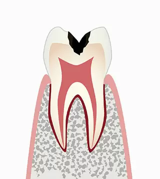 C2（シーツー）:象牙質の虫歯