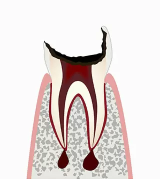 C4（シーフォー）:歯髄が壊死した虫歯