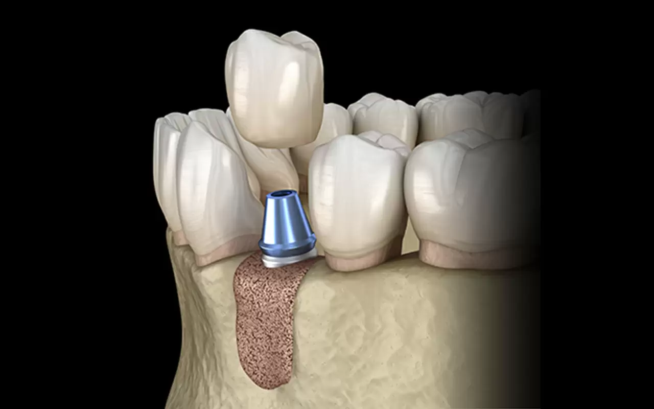 GBR法(骨誘導再生法)