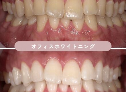 オフィスホワイトニングの症例| 東三国新大阪ララ歯科