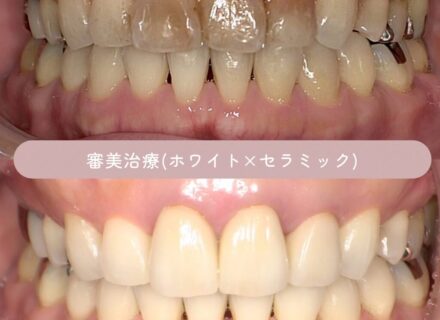 セラミック×ホワイトニングの症例| 東三国新大阪ララ歯科